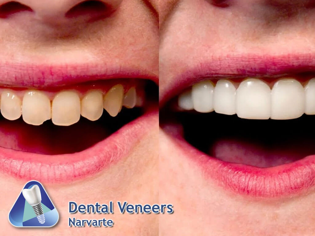 Dental Veneers Narvarte