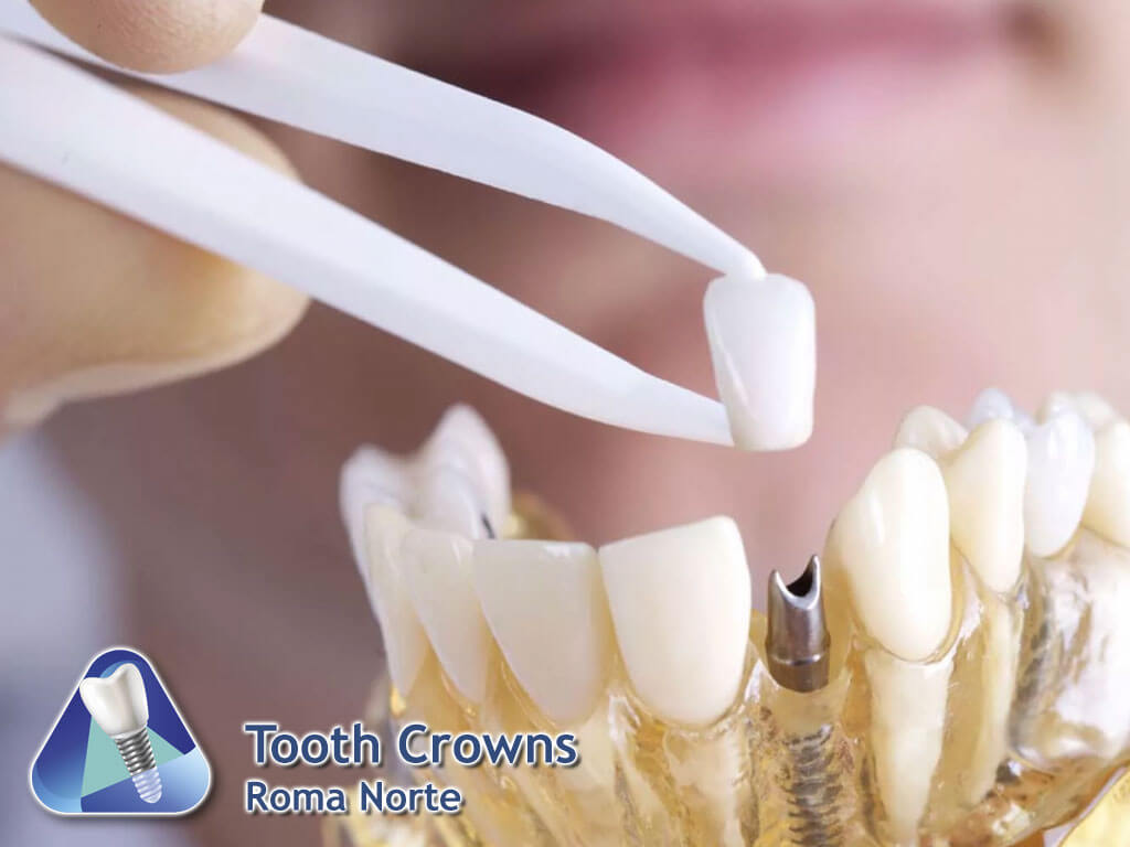Tooth Crowns Roma Norte