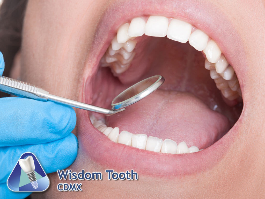 Wisdom Tooth CDMX
