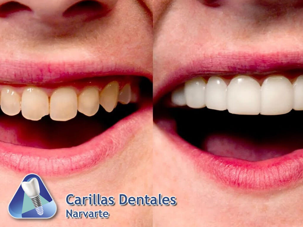 Carillas Dentales Narvarte