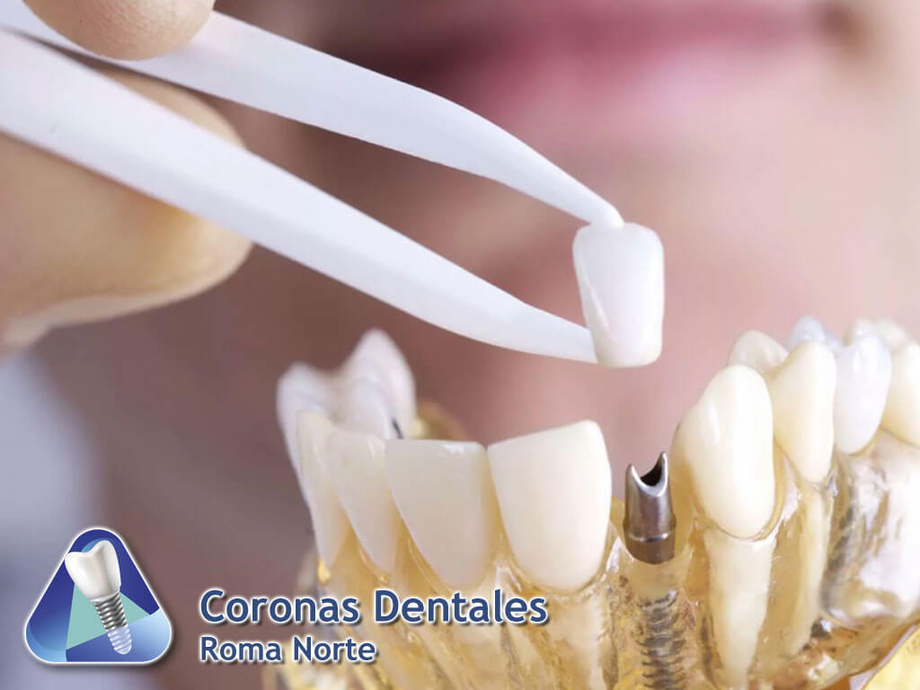 Coronas Dentales Roma Norte