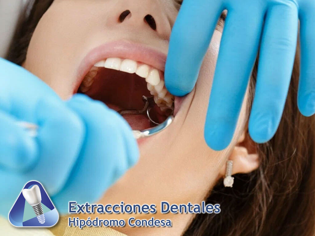 Extracciones Dentales Hipódromo Condesa
