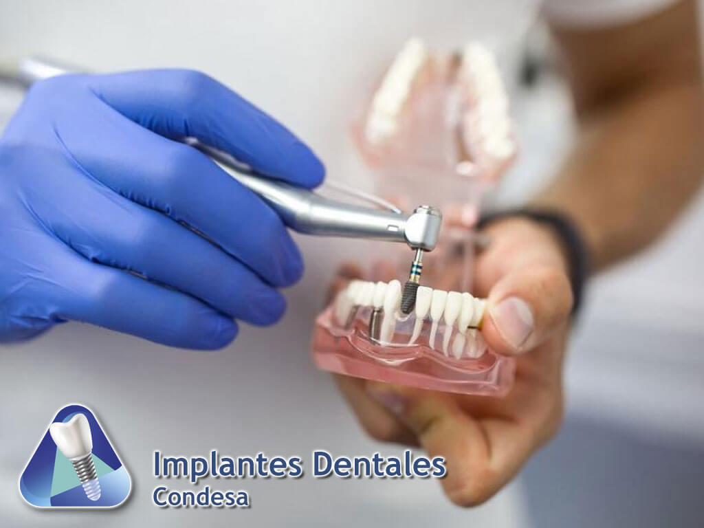 Implantes Dentales Condesa