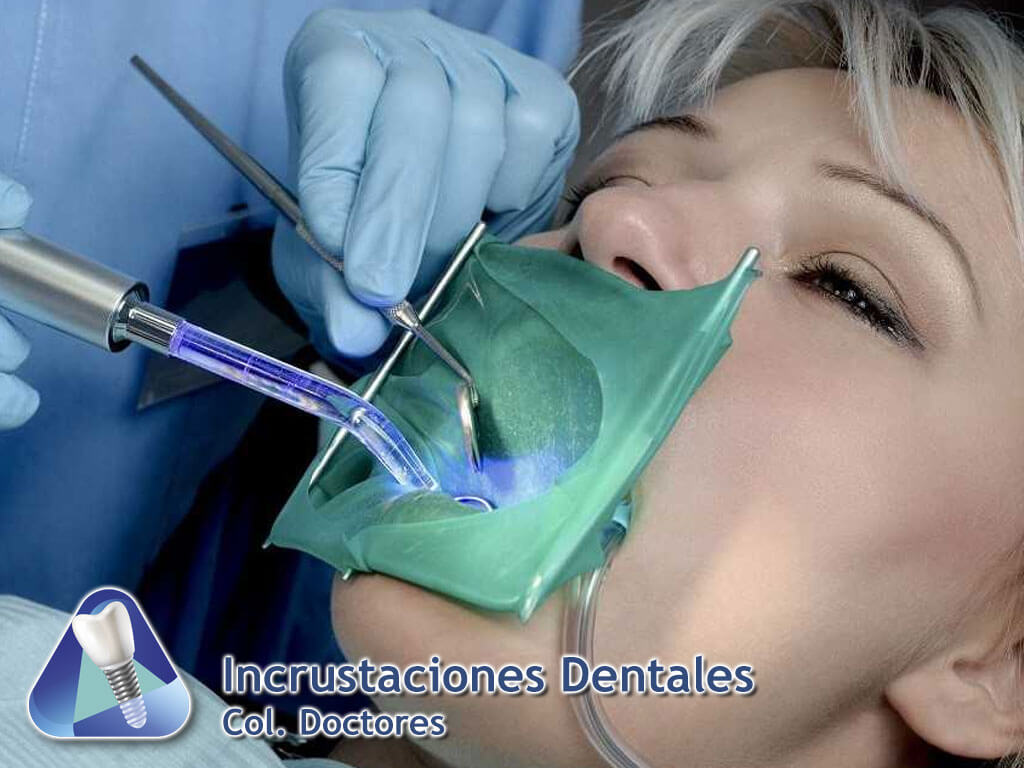 Incrustaciones Dentales Col. Doctores