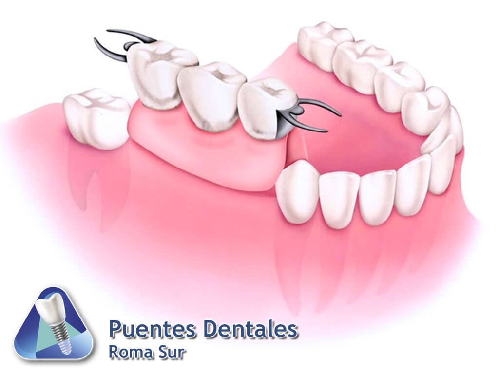 Puentes Dentales Roma Sur