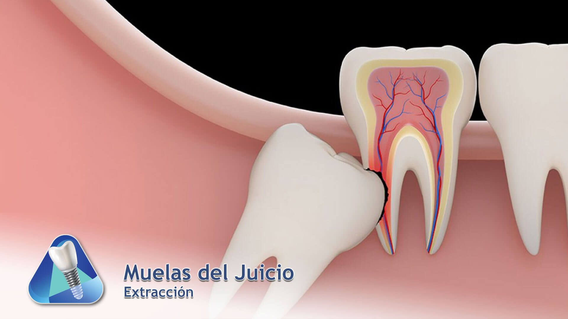 Muelas del Juicio
