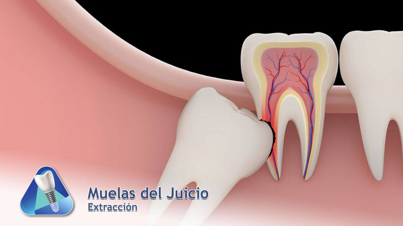 Muelas del Juicio