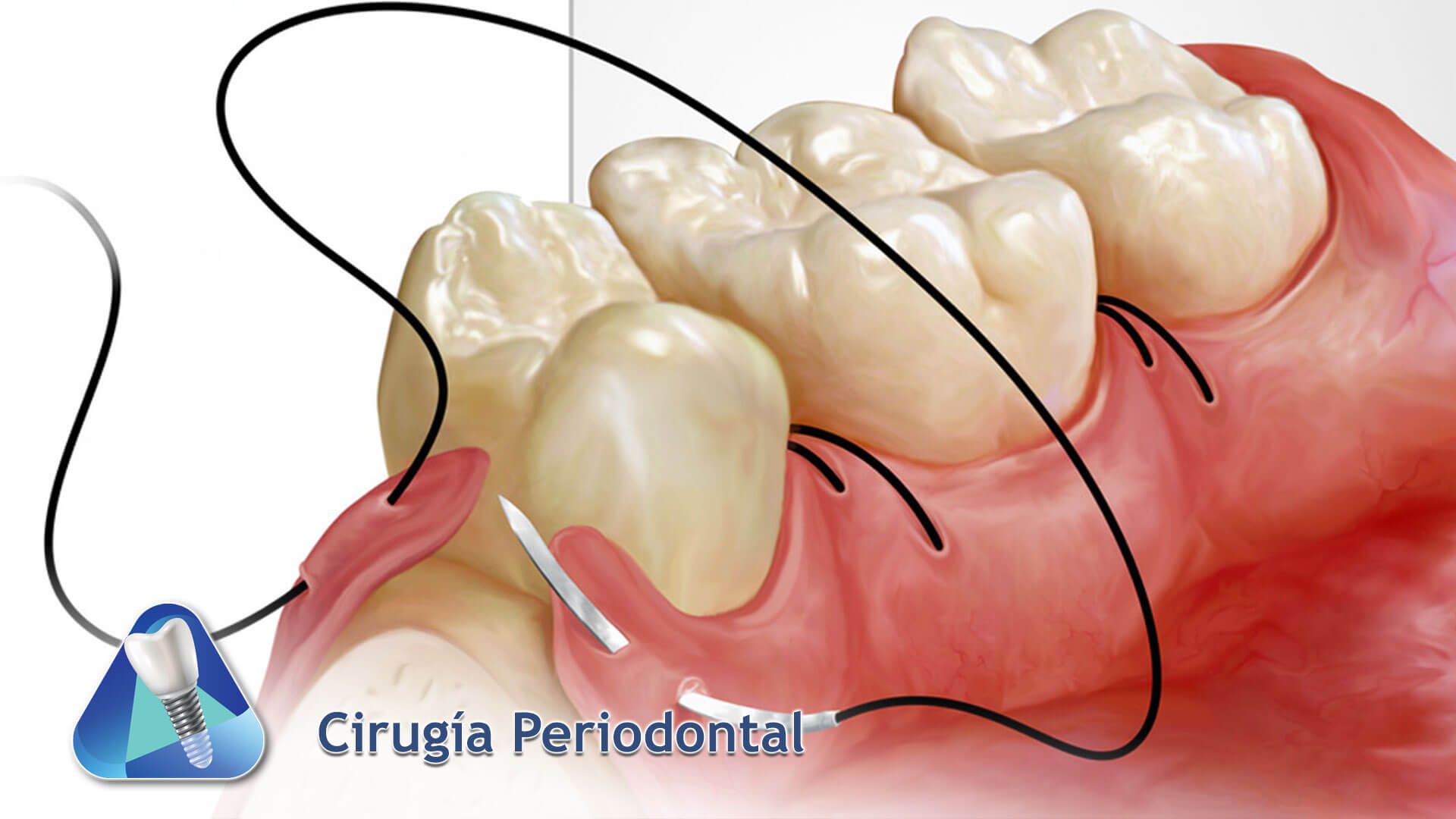 Cirugía Periodontal