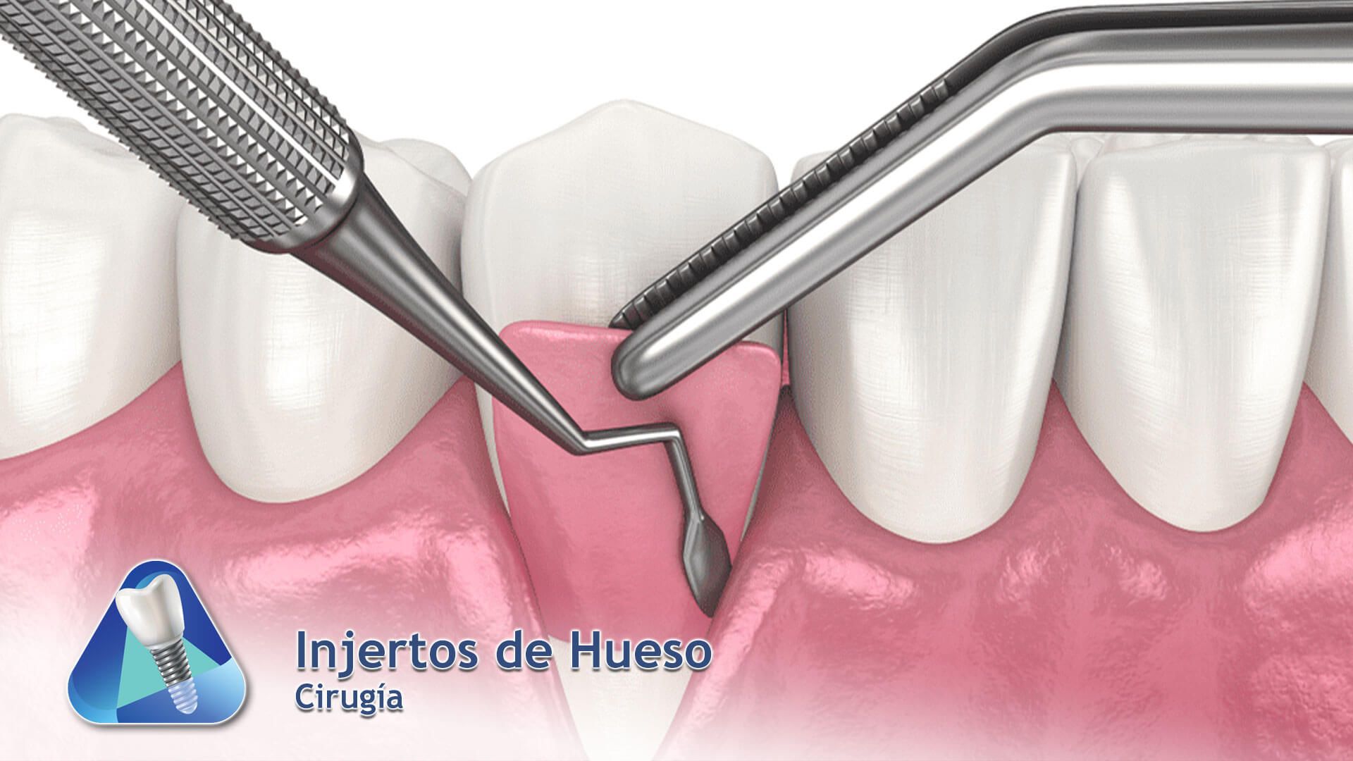 Injertos de Hueso