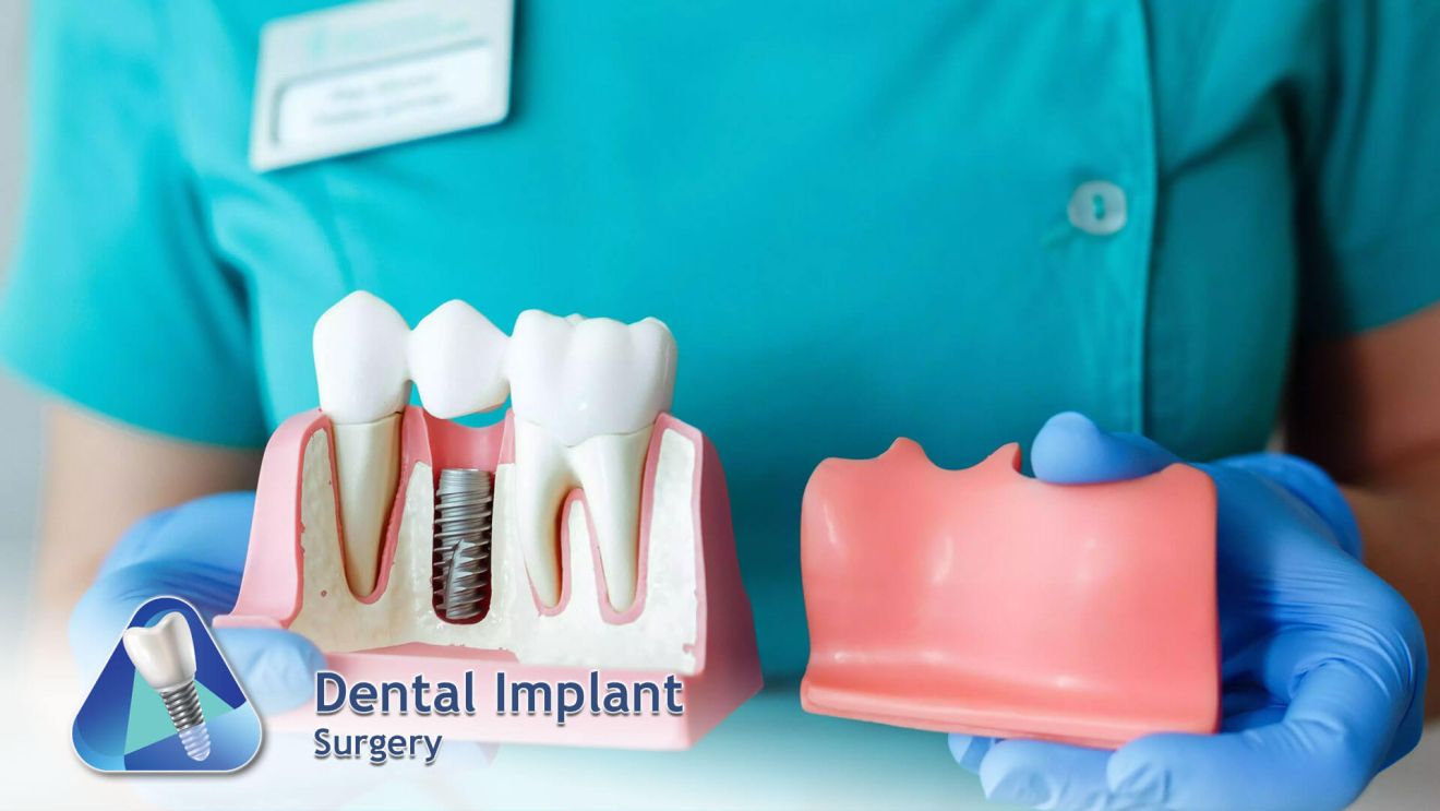 Dental Implants