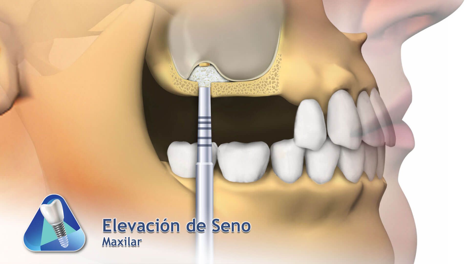 Elevación de Seno Maxilar