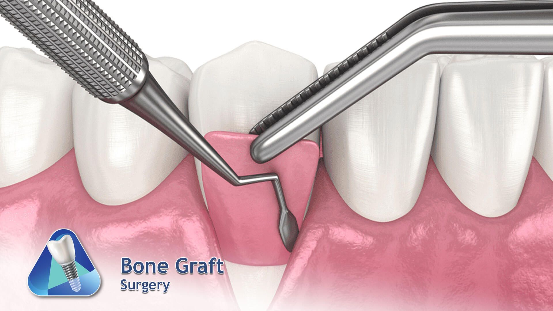 Bone Graft Surgery