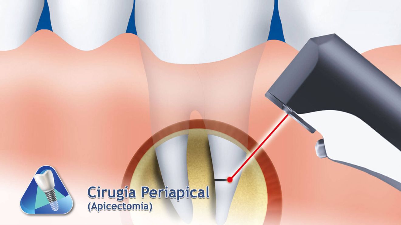 Cirugía Periapical - Apicectomía