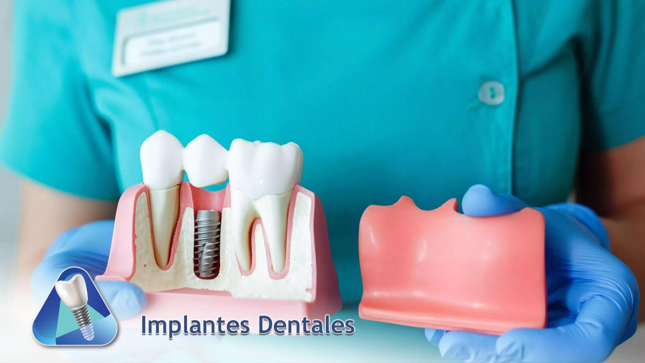 Implantes Dentales