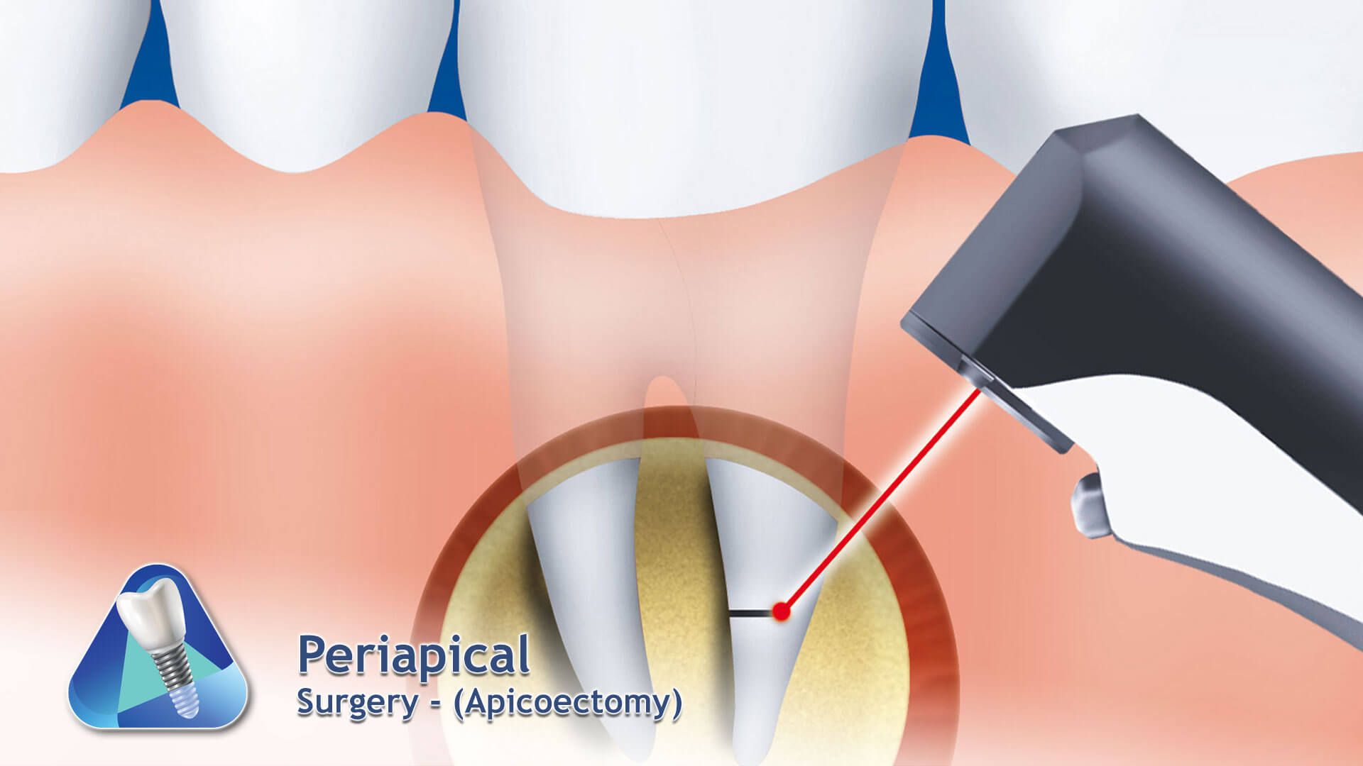 Bone Graft Surgery