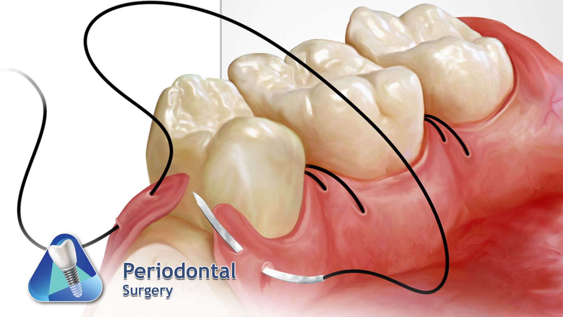 Periodontal Surgery
